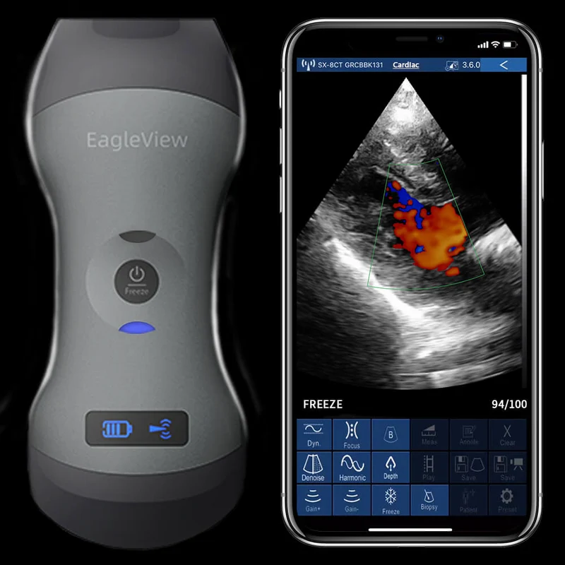 EagleView™ ワイヤレスプローブ型超音波スキャナ