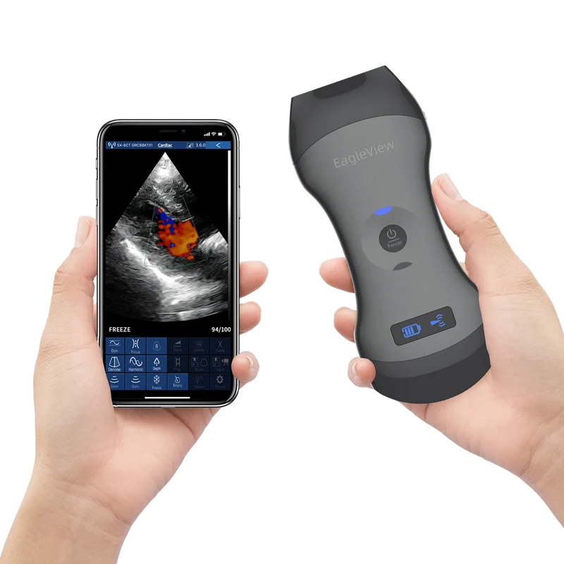EagleView™ ワイヤレスプローブ型超音波スキャナ