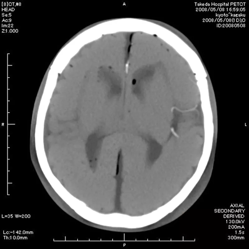 Erler-Zimmer Angiographie Kopfmodell